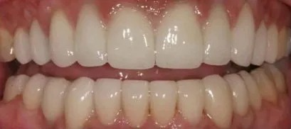 Full mouth rehabilitation - after