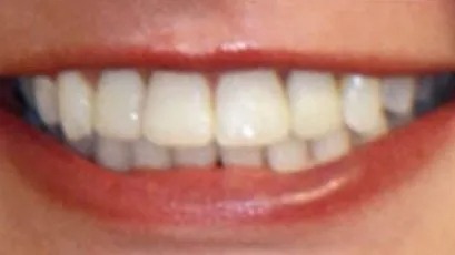 Smile alignment & whitening - after