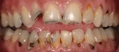 Full mouth rehabilitation - before
