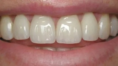 Chipped front teeth restoration - after