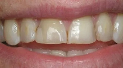 Chipped front teeth restoration - before