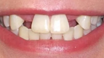 Smile alignment & whitening - before
